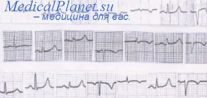 EKG magas vérnyomás - kezelés a szív