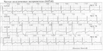 Beats az EKG