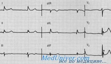 EKG magas vérnyomás - kezelés a szív