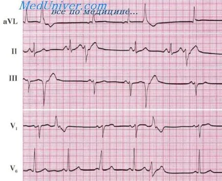 compus extrasistolele de atrioventricular