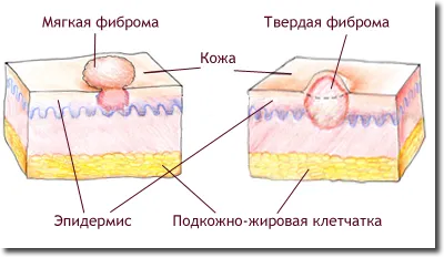 Fibroma csont - hogyan nyilvánul-e kezelni