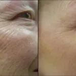 peeling hialuronic