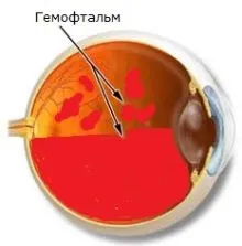 Ochii hemoftalm - cauzele si tratamentul bolilor