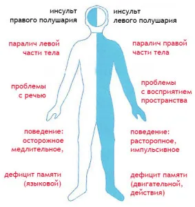 Хеморагичен инсулт от дясната страна - причини, симптоми, лечение