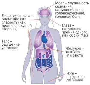 Хеморагичен инсулт от дясната страна - причини, симптоми, лечение