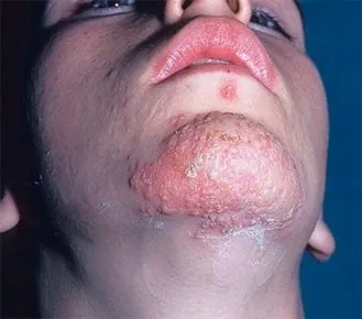 Herpes pe fața rațiunii, fotografii ca remediu rapid