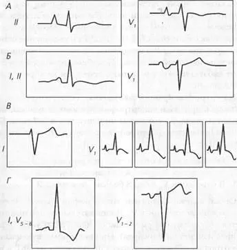 Miocardica hipertrofia - semne ECG