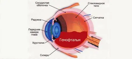 Ochii hemoftalm - cauzele si tratamentul bolilor