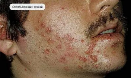 Herpes pe fața rațiunii, fotografii ca remediu rapid