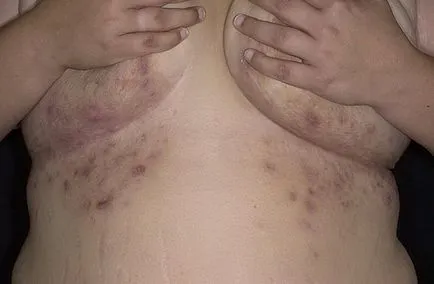 Hidradenitis по време на бременност - гноен възпаление на потните жлези