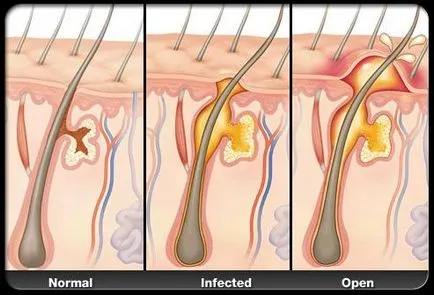 Hidradenitis - boli infectioase inflamatorie a axilelor