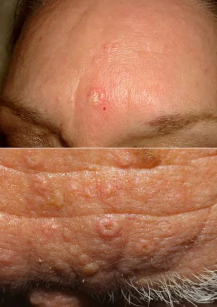 Хиперплазия на мастните жлези жлеза - просто подутини по кожата или една здравна опасна патология