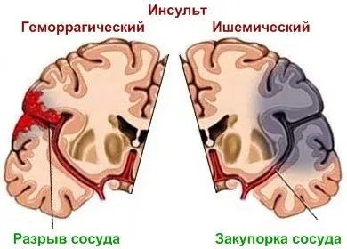 инсулт