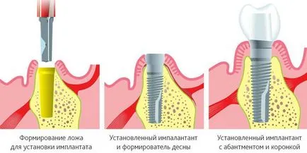 implanturi dentium - avantaje și caracteristici ale sistemelor coreean-a făcut