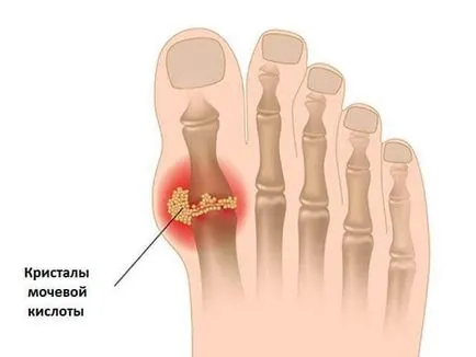 Fapte interesante nu le stiai despre boala Gout