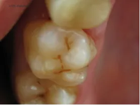 Efectuarea protezelor dentare