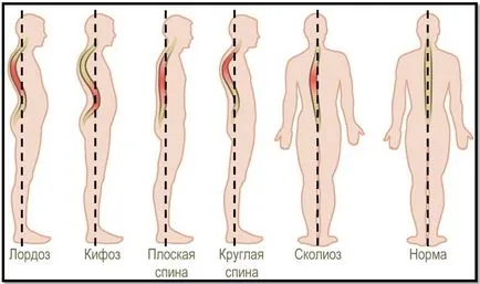 Curbarea coloanei vertebrale, ca remediu, tipuri, simptome și tratament