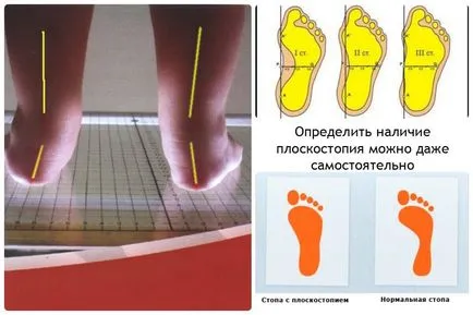 Cum de a trata platfus și copil în picior stramb