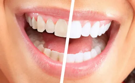 Cum de a albi dintii la metode acasă populare și tehnici pentru video
