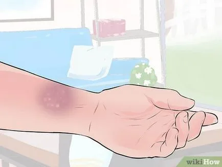 Как да се разграничи напрежение и счупване на ръката