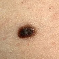 16. tünetei melanoma, mit kell tennie, ha talál egy