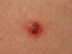 16. tünetei melanoma, mit kell tennie, ha talál egy