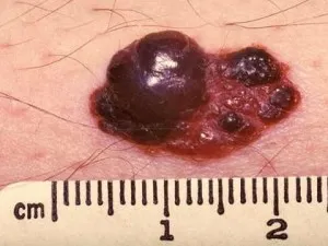 16. tünetei melanoma, mit kell tennie, ha talál egy