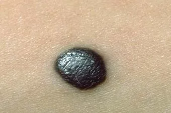 16. tünetei melanoma, mit kell tennie, ha talál egy