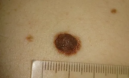 16. tünetei melanoma, mit kell tennie, ha talál egy