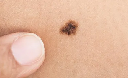 16. tünetei melanoma, mit kell tennie, ha talál egy