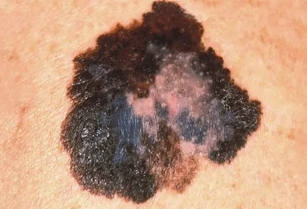 16. tünetei melanoma, mit kell tennie, ha talál egy