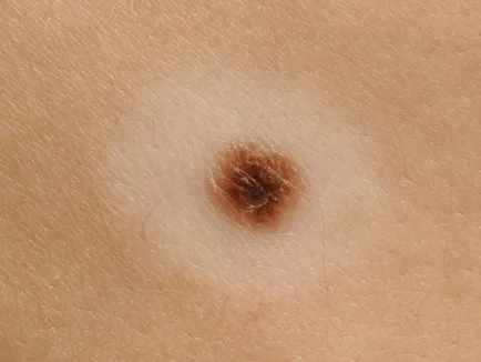 16. tünetei melanoma, mit kell tennie, ha talál egy