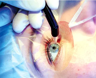 Hogyan lehet visszaállítani látás a műtét után glaukóma körülbelül szembetegség