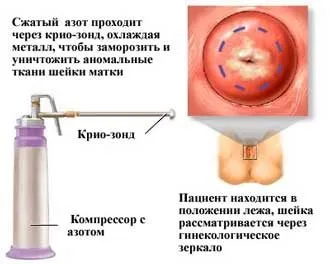 цервикални цистообразуващи симптоми, лечение, видове операции