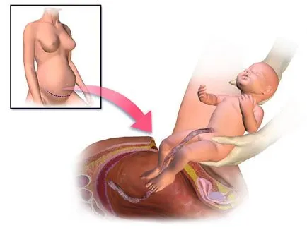 Cesarean Secțiunea 1