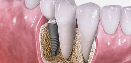 Coreeană privire de ansamblu implanturi dentare din cele mai populare modele