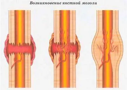 Колъс какво е, нейните симптоми, причини и лечение