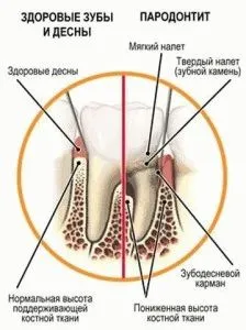 Tratamentul unității vector periodontitei
