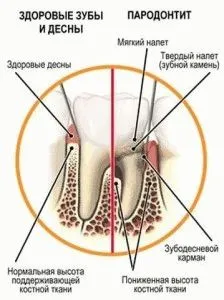 Paradentózis gyógyítása egység vektor