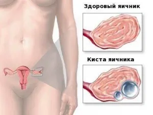 Tratamentul de chisturi ovariene remedii populare