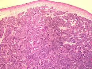 Hidradenitis SUP- kezelés egy korai szakaszban, amely