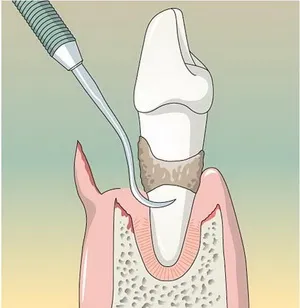 лечение на венците, отворен и затворен кюртаж