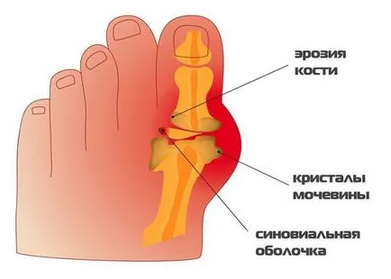 А лек за подагра - преглед на най-добрите препарати