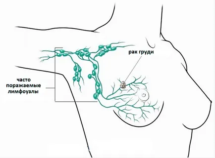 Limfostazom kezében eltávolítása után emlő betegség tünetei