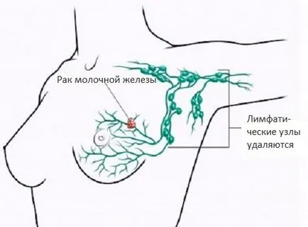 Limfostazom ръце след отстраняване на гърдата - лечение и прогноза