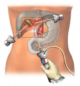 Metastaze hepatice de cancer de predictie - tratament si prevenire