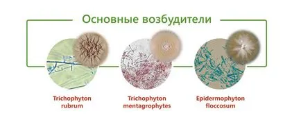 Атлет лечение крак, симптоми, лекарства, снимка, как да се отнасяме кел ходилата