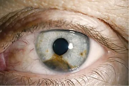 на ретината на очите меланом прогноза и продължителността на живота