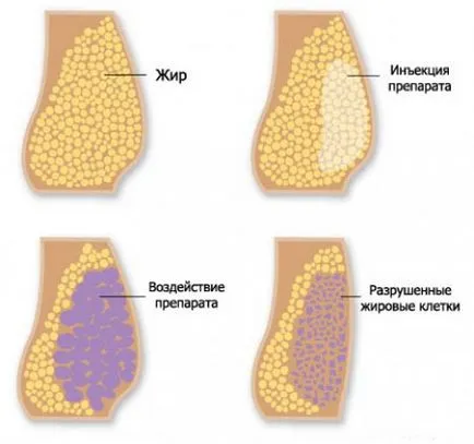 Mezoterápia narancsbőr alapján tesztelt magát