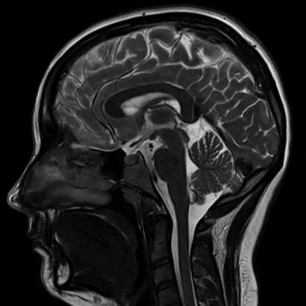 MRI a fej - az agy, artériák és vénák, vérerek, hipofízis, pályára, orrmelléküregek